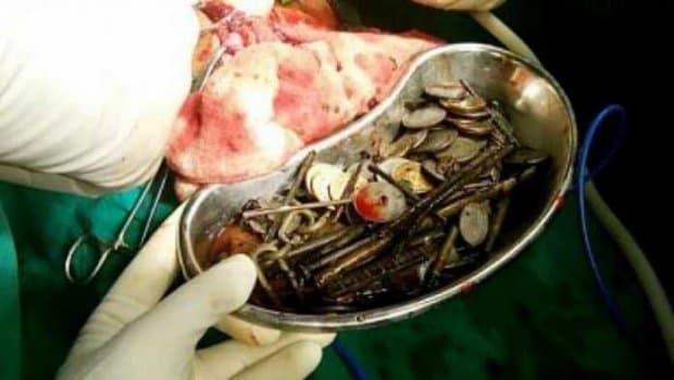 Hindistonlik erkak oshqozonidan 263 ta tanga, yuzlab mix, it boylaydigan zanjir chiqdi