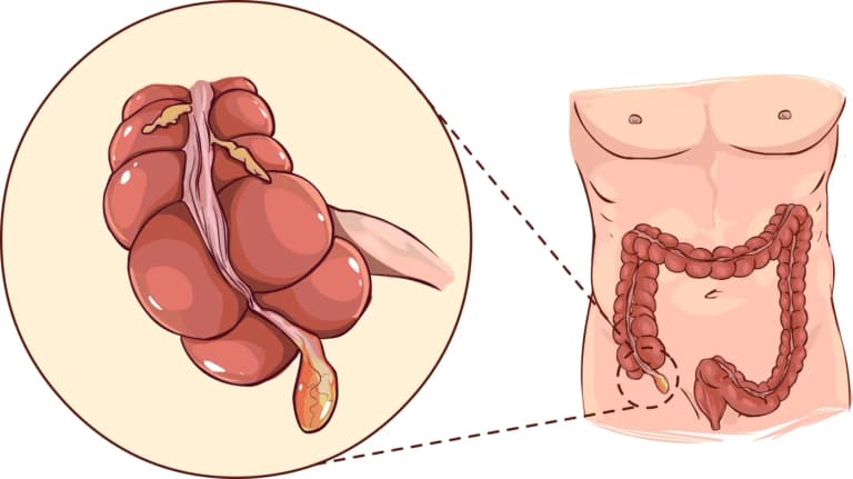 Siz hayron qolasiz: appendiksdan qandaydir foyda bormi?