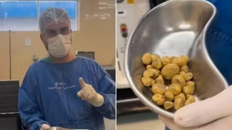 Günde üç litre kola: vücudundan 35 taş çıkarıldı (video)