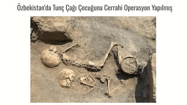 Ўзбекистонда 4 минг йиллик сирли жарроҳлик излари топилди