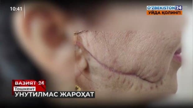 Toshkentda xotinining yuzini lezviya bilan kesgan erkakka qamoq jazosi tayinlandi