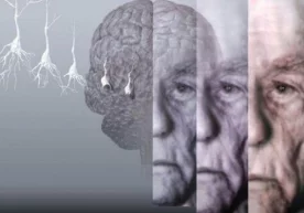 Мия хужайралари атрофияси ва деменцияда беморнинг ташқи