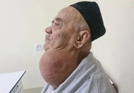 Самарқандда шифокорлар ноёб ва бир қарашда имконсиздек