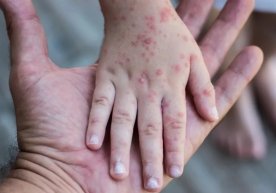 Rossiyada bog‘cha va maktablarda yangi virus tarqalmoqda фото