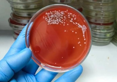 Yaponiyada “go‘shtxo‘r bakteriya” keltirib chiqaradigan xavfli kasallik tarqaldi фото