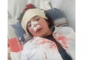 Farg‘onada bemor va uning onasi hamshirani urib, burnini sindirdi фото