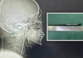 Хитойда бир эркакнинг томоғида 8 йил давомида 12