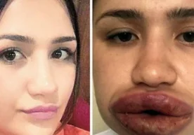 22 ёшли туркиялик Мерве Келеш лабларини тўғрилашни хоҳлади