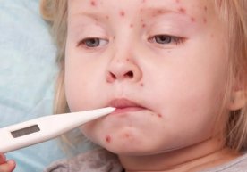 Энфилд ҳудудида 60 дан ортиқ болада қизамиқ касаллиги қайд