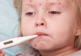 Enfild hududida 60 dan ortiq bolada qizamiq kasalligi qayd