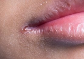 Оғиз атрофида учрайдиган учиқ чиқишлар (яралар ёки