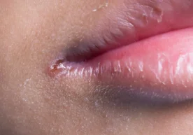 Оғиз атрофида учрайдиган учиқ чиқишлар (яралар ёки