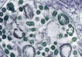 Эфиопияда хавфли Марбург вируси тарқалмоқда. Жанубий Судан