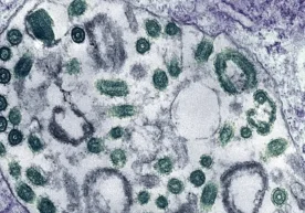 Эфиопияда хавфли Марбург вируси тарқалмоқда. Жанубий Судан