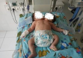 Самарқанд вилоятида 27 июнь куни икки бошли чақалоқ дунёга
