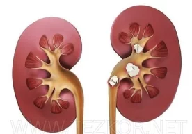 Буйракда тошлар тўпланиб қолган бўлса, уни витаминга бой