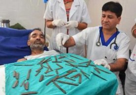 Bir erkakning oshqozonidan 40 ta metall buyum topildi фото