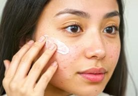 Ҳуснбузар (угри) — кўпчиликни безовта қиладиган терининг