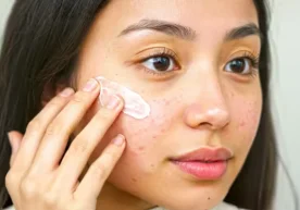 Ҳуснбузар (угри) — кўпчиликни безовта қиладиган терининг