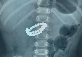 Қозоғистонда шок ҳолат: 1 ёш 9 ойлик бола 31 та магнитни