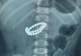 Қозоғистонда шок ҳолат: 1 ёш 9 ойлик бола 31 та магнитни