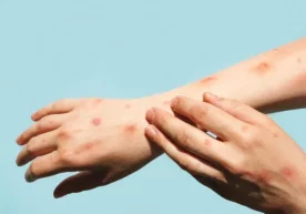 Маймунчечак — бу вирусли касаллик бўлиб, унинг юқиш