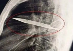 Танзанияда 44 ёшли эркакнинг ҳайратланарли воқеаси
