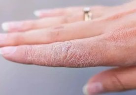 Қуруқ тери — ҳар куни миллионлаб одамларни безовта