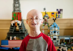 Фото: Getty Images Эрта қариш синдроми — прогерияга