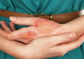 Тери куйишини даволаш фақат малакали шифокор томонидан