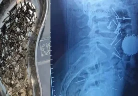 A rare but alarming medical case was recorded in