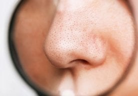 Кўпчиликнинг бурун устида пайдо бўладиган қора нуқталар