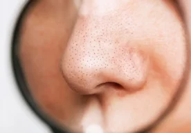 Кўпчиликнинг бурун устида пайдо бўладиган қора нуқталар