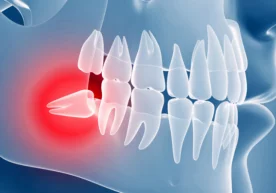 Фото: «Dentarus.com» Ақл тиши — «саккизлик» қаторидаги