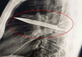Танзанияда шифокорлар ноодатий ҳолатга дуч келишди: улар
