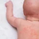 Heat rash is a skin condition caused by blocked sweat