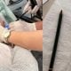 Туркиянинг Агри вилоятида шифокорлар амалга оширган