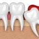 The wisdom teeth are the last growing teeth located at the