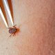 Иқлим ўзгариши туфайли Lyme касаллигини тарқатувчи каналар