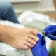 InGrown tirnoqlar, ya’ni tirnoqning chetki qismi atrofdagi
