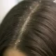 Dandruff refers to the flaking of the scalp skin, often