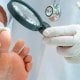 Foot fungus (mycosis) is an infectious disease of the skin