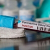 Farg‘onada bemor koronavirus yuqtirdim deb vahima ko‘tardi