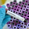Koronavirus aniqlangan eng so‘nggi bemor haqida ma’lumot berildi