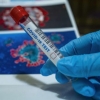 Koronavirusdan tuzalgan inson virus tashuvchi bo‘lib qoladimi?