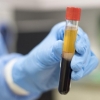 Koronavirus asoratlari va o‘lim omillari aniqlandi