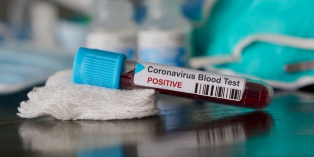 O‘zbekistonda koronavirusdan zararlanishning yana bir holati qayd etildi