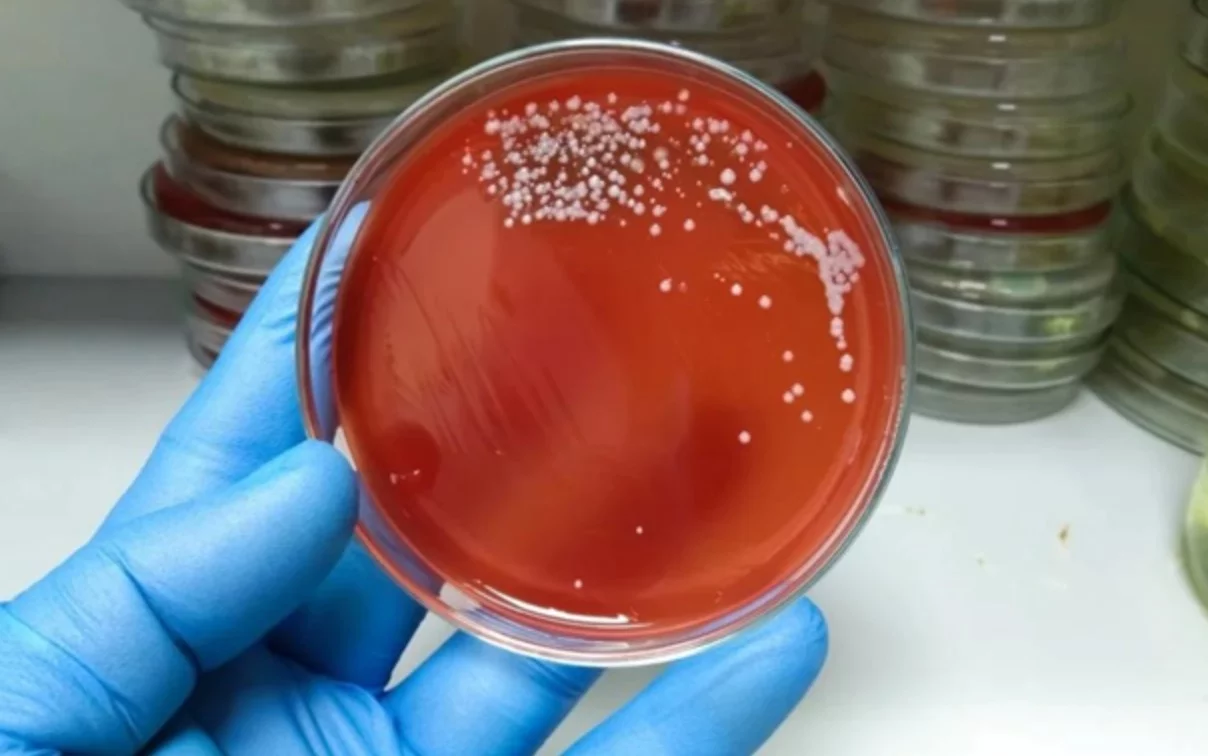 Японияда “гўштхўр бактерия” келтириб чиқарадиган хавфли касаллик тарқалди