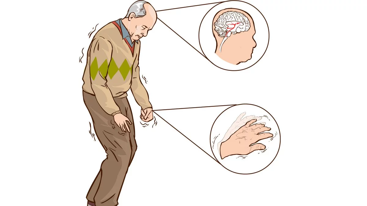 Parkinson kasalligi rivojlanayotganidan darak beruvchi 7 ta simptom