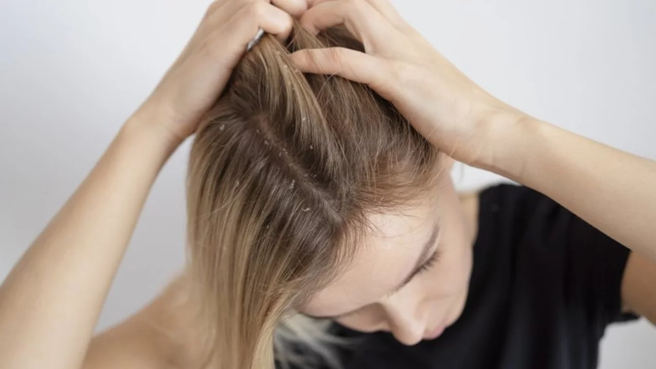 Learn 3 important secrets to getting rid of dandruff forever!
